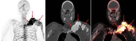Σκελετική Απεικόνιση με F-NaF PET/CT Καλοήθη