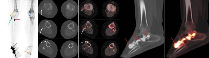 Σκελετική Απεικόνιση με F-NaF PET/CT Καλοήθη