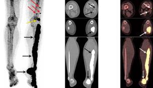 Σκελετική Απεικόνιση με F-NaF PET/CT Καλοήθη Νοσήματα των Οστών Μελορεόστωση Προοπτική Αξιολόγηση του F-NaF PET/CT σε ασθενείς με μελορεόστωση. 30 ενήλικες χωρίς κληρονομική σύνδεση.