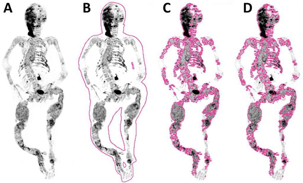 Σκελετική Απεικόνιση με F-NaF PET/CT Καλοήθη Νοσήματα