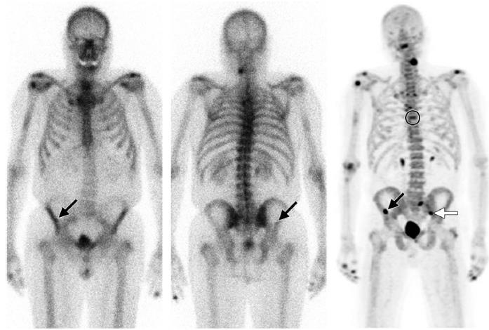Σκελετική Απεικόνιση με F-NaF PET/CT Ανίχνευση Οστικών Μεταστάσεων 77 ετών άνδρας με Ca προστάτη επίπεδα PSA 99m Tc-MDP ύποπτη βλάβη στη ΔΕ