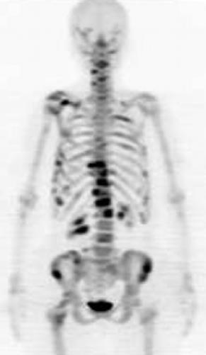 Σκελετική Απεικόνιση με F-NaF PET/CT