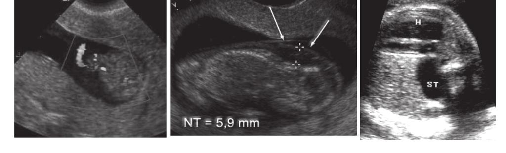 Εικόνα 1. Υπερηχογραφικά ευρήματα σε έμβρυο με Beckwith-Wiedemann syndrome: ομφαλοκήλη, αυξημένη αυχενική διαφάνεια, διαφραγματοκήλη.