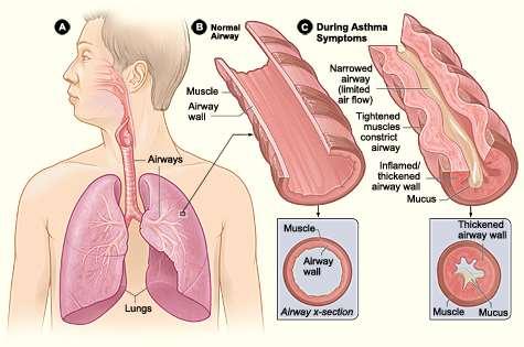 Άσθμα