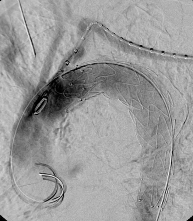 ραγέν ανεύρυσμα Ασυμπτωματικό ανεύρυσμα > 6 cm αύξηση