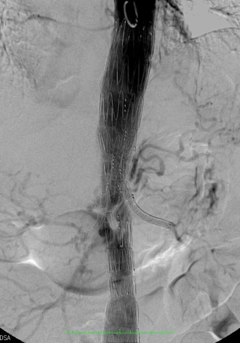 μόσχευμα (branched endograft) Ένδειξη