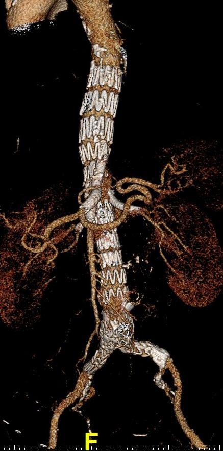 5 cm αύξηση της διαμέτρου > 1cm μέσα σε 1