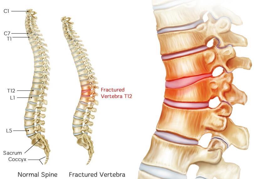 Αποκατάσταση - Sport rehabilitation and pain management Η σπονδυλοδεσία σε επαγγελματία αθλητή (spinal fusion) Η σπονδυλοδεσία είναι γενικά μια έσχατη λύση για τον αθλητή με δισκογενή πόνο και θα