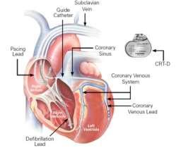Καταγραφι επειςοδίων Atrial