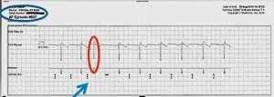 far-field ventricular sensing, premature atrial