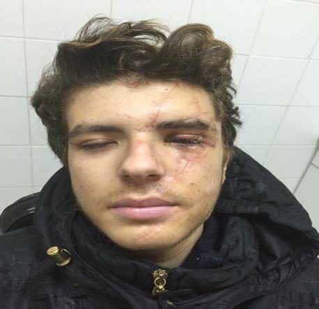 Σοβαρή αιμορραγία από τους κλάδους της έξω καρωτίδας στο