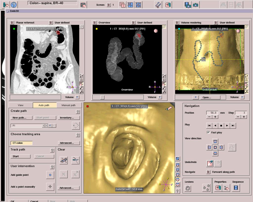Virtual Endoscopy Εικονική Ενδοσκόπηση Μη επεμβατική, εικονική προσομοίωση του συμβατικού ενδοσκοπίου Χρήση SSD και VR τεχνικών