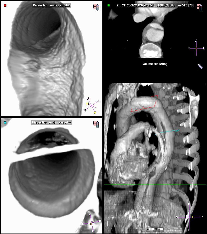 Virtual Endoscopy Εικονική