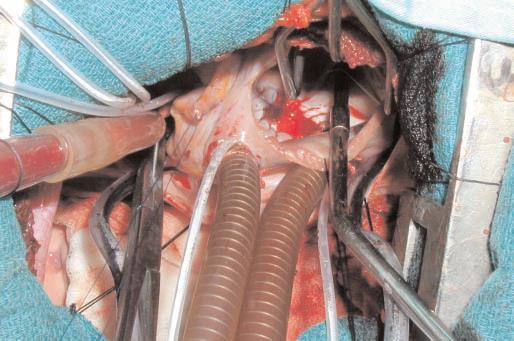 right anterolateral thoracotomy in 242 patients: a