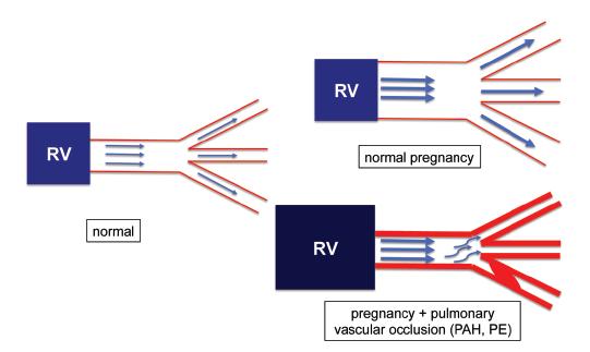 The mechanical and hormonal changes of pregnancy affect each major Worsening of PAH frequently occurs in pregnancy and organ system.
