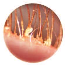 Blepharitis in the United States 009: