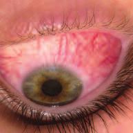 Blepharitis.