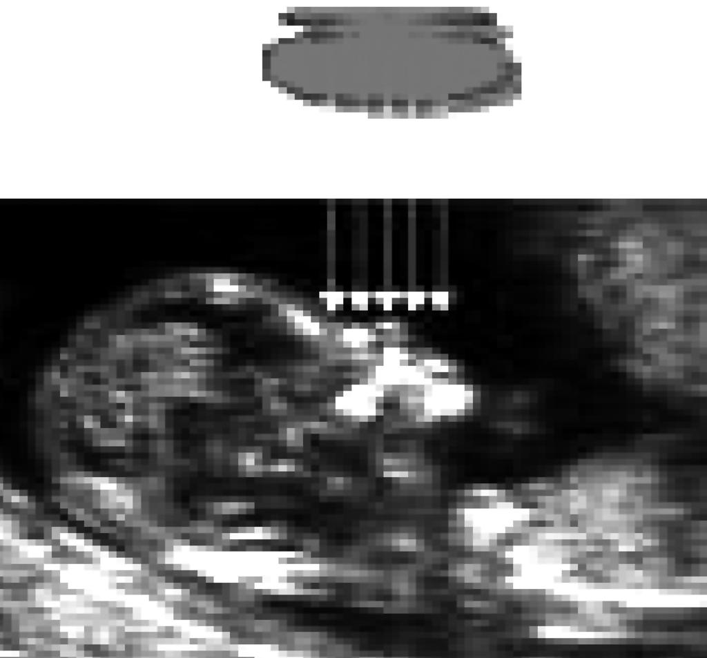 Η αυχενική διαφάνεια και το ρινικό οστό στην ανίχνευση του Σ. Down Αποστολίδης και συν. Τοποθέτηση της κεφαλής των υπερήχων κάθετα στο πρόσωπο του εμβρύου κατά την απεικόνιση του ρινικού οστού.