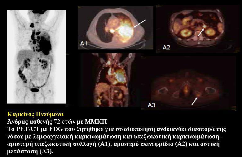 Εικόνα 14. PET/CT. Άνδρας ασθενής 72 ετών με μεγάλη απώλεια βάρους, αδυναμία και βήχα.