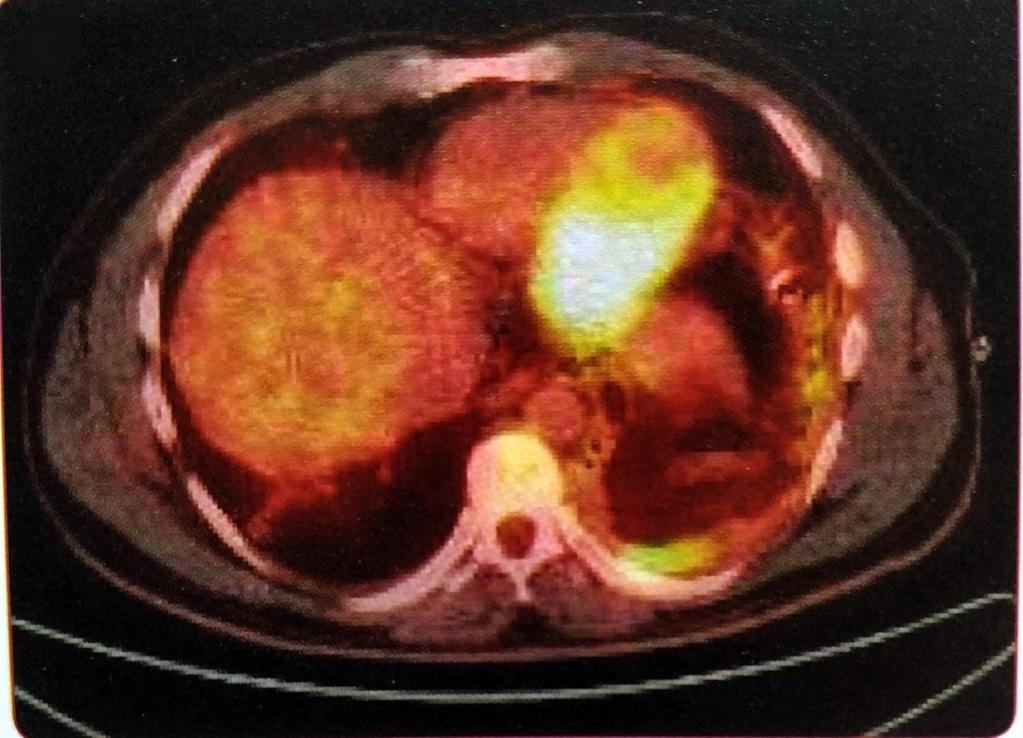 Εικόνα 15. Εγκάρσια τομή PET/CT.