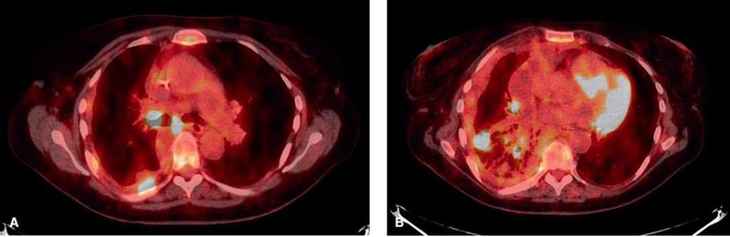 Εικόνα 16. PET/CT. Γυναίκα ασθενής ηλικίας 60 ετών με μικτό καρκίνο του πνεύμονα (ΜΚΠ και ΜΜΚΠ) και εντοπισμένη υπεζωκοτική συλλογή.