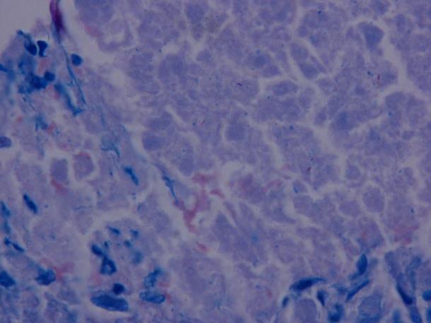 Antituberculous treatment IREP IR IREPM IRE Infliximab Methylprednisolone Etanercept Reactivation Breakthrough Tuberculosis