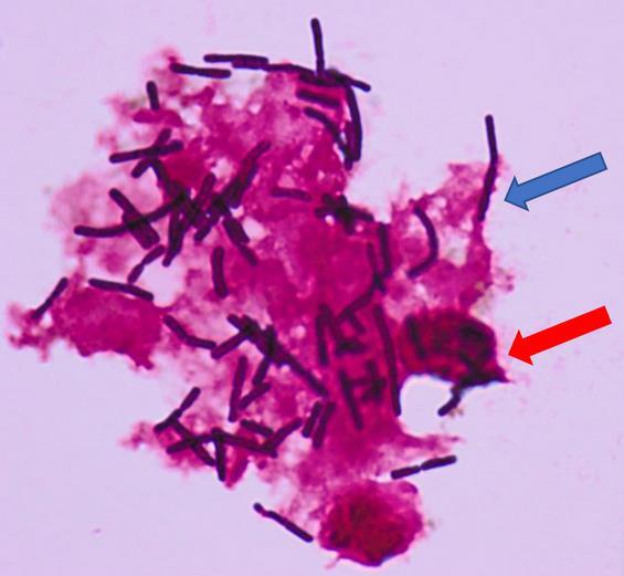 Η Καντιντίαση προκαλείται από Candida albicans (Εικόνα 17). Κλινικά, εμφανίζεται ως μία λευκή, πηκτή, άοσμη έκκριση και μπορεί να συνδέεται με αίσθημα κνησμού στο αιδοίο.
