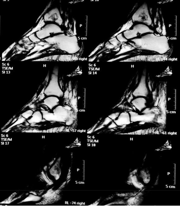 178 HJM GPA is dated approximate ten years ago based on skin lesions, acute loss of hearing aquity, pulmonary nodules with cavities which was associated with the presence of ANCA specific antibodies
