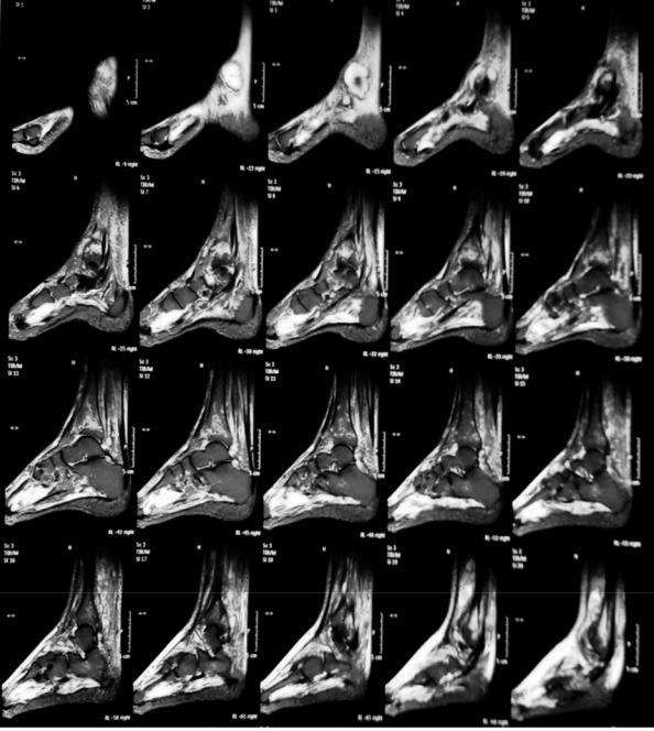 At the time of admission to administrate the 4th treatment with RTX the patient was suffering of intensive pain in right tibia and right ankle joint with no others clinical manifestations and normal