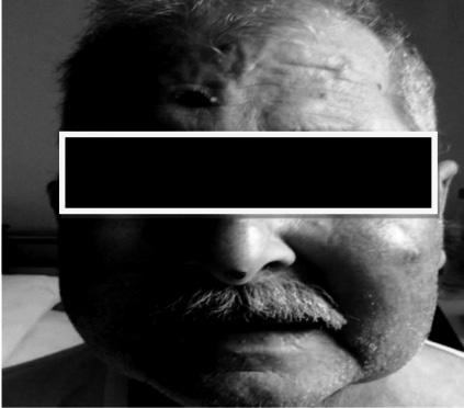 Inhalation is the most common route of infection with direct inoculation into the skin being second 5. Then it can cause pulmonary, central nerve system, skin or systemic infections 6.