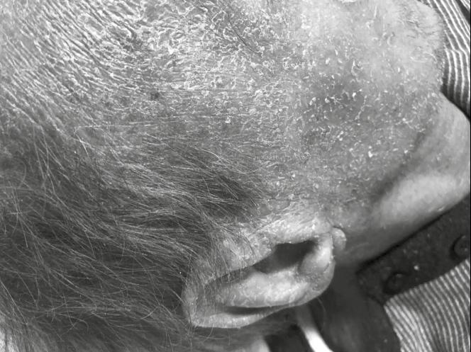 Οι τομές από τον λεμφαδένα ανέδειξαν σχεδόν πλήρη κατάργηση της αρχιτεκτονικής του δομής λόγω διήθησης από μέσου κυρίως μεγέθους νεοπλασματικά λεμφοειδή κύτταρα με υποστρόγγυλους ή ελαφρά