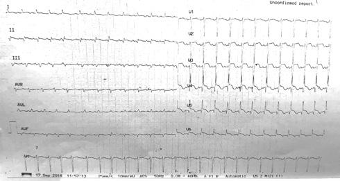 Επίσης τροπονιναιμία (hs Trop-I: 6469 pg/ml) και από το υπερηχοκαρδιογράφημα εικόνα ακινησία κορυφής και πέριξ τμημάτων του μυοκαρδίου, τύπου μυοκαρδιοπάθειας Takotsubo, με κλάσμα εξώθησης 25%.