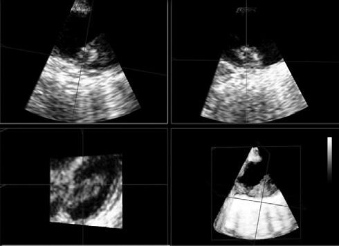 Echocardiography contributes significantly to the investigation of the cause of embolic episodes.