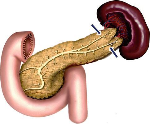 Σχήμα 12: Fishtail pancreas[28] 7.