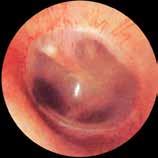 4 ISSUE 3 ISSN 224-908X OFFICIAL JOURNAL OF THE: Panhellenic Society of Otorhinolaryngology - Head &
