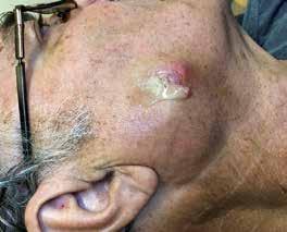 Ξένο σώμα παρωτίδας Εικ.. Άνδρας 65 ετών με επίμονη εκροή πύου από τη δεξιά παρωτιδική χώρα. Εικ. 2.