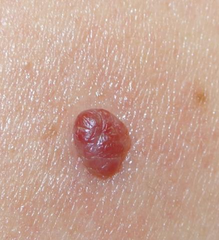 Κερασόχρωο Αιμαγγείωμα (Cherry Angioma) Λευκά