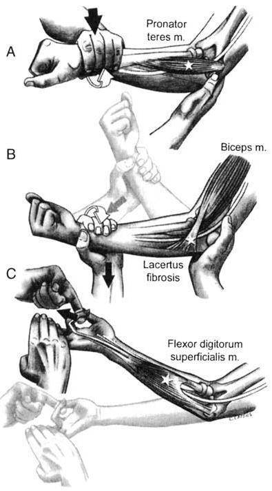 4) Ο επιπολής καμπτήρας των δακτύλων μυ (flexor digitorum muscle) (4). Εικόνα 6 Υπερκονδύλια απόφυση και ο σύνδεσμος του Struthers. https://emedicine. medscape.