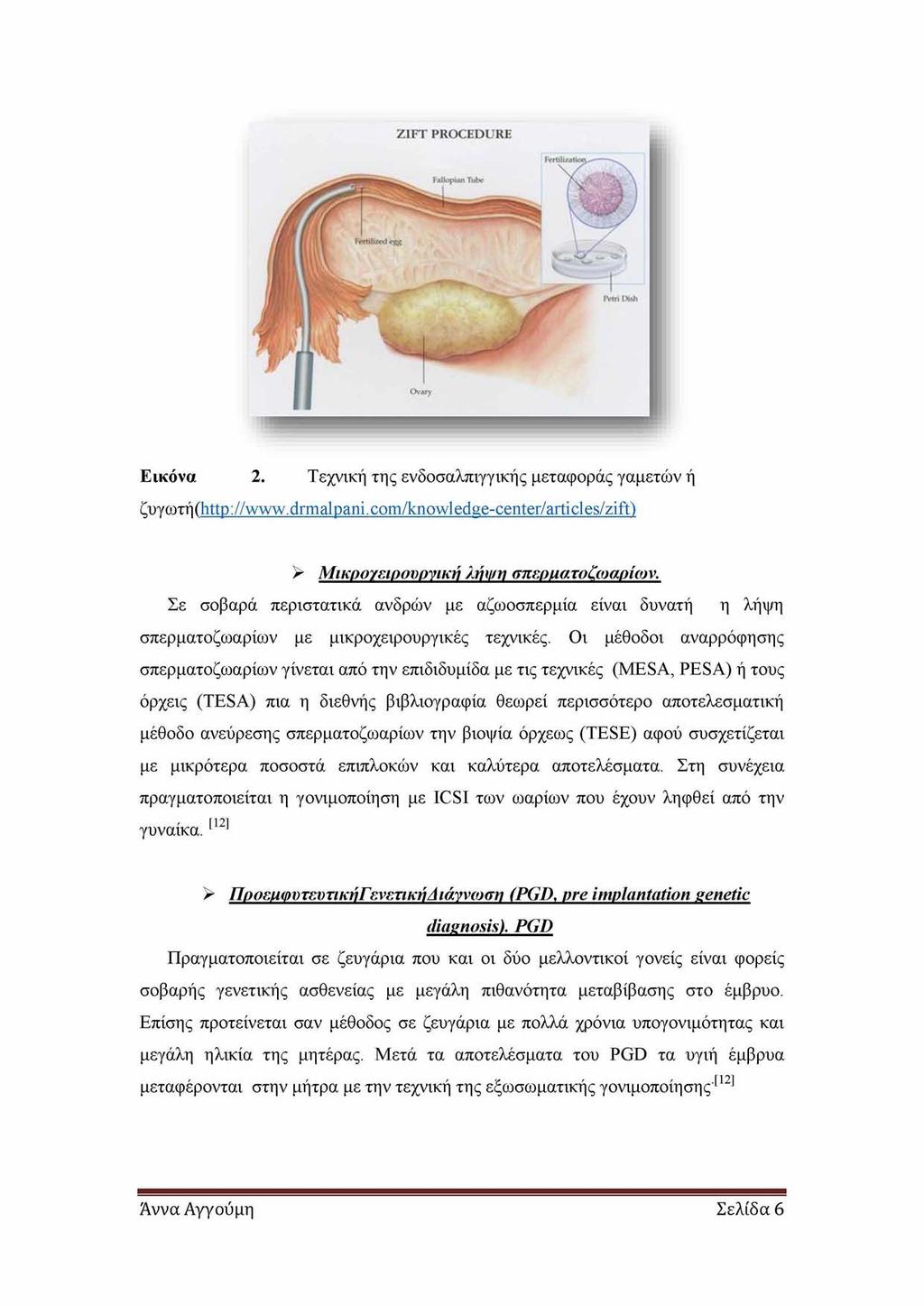 Εικόνα 2. Τεχνική της ενδοσαλπιγγικής μεταφοράς γαμετών ή ζυγωτή (http://www.drmalpani.com/knowledge-center/articles/zift) > Μικρογειρουργική λήψη σπερματοζωαρίων.
