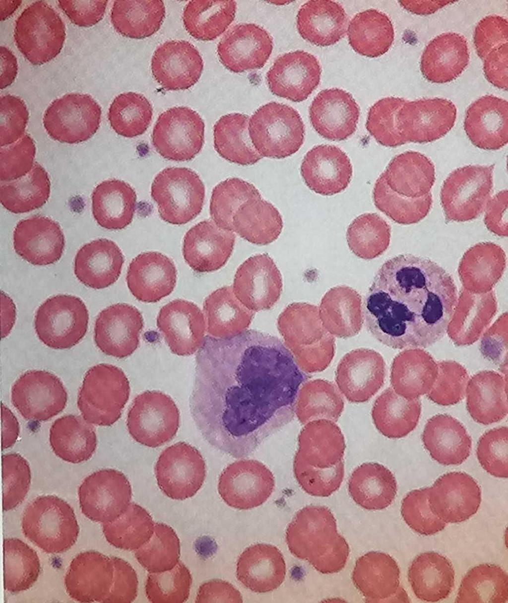 Επίχρισμα περιφερικού αίματος Ερυθρά-Red Blood cells