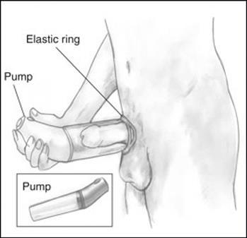 Ελαστικός δακτύλιος Συσκευή κενού Τοποθέτηση Δημιουργία κενού Ελαστικός δακτύλιος Εικόνα 4.6. Ιατρικές συσκευές κενού (χειροκίνητη και ηλεκτρική) για τη θεραπεία της στυτικής δυσλειτουργίας. 4.2.