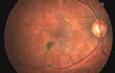 της βιβλιογραφίας > 30 ΓΛΑΥΚΩΜΑ_ Η μελέτη TAGS (Treatment of Advanced Glaucoma Study) και η σημασία της στην αντιμετώπιση του προχωρημένου γλαυκώματος > 34 ΒΙΒΛΙΟΓΡΑΦΙΚΌ CATCH UP!
