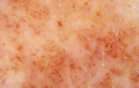 αγγείων Περιοχές χωρίς αγγεία ( οίδημα) Arch Dermatol 2008; 144: