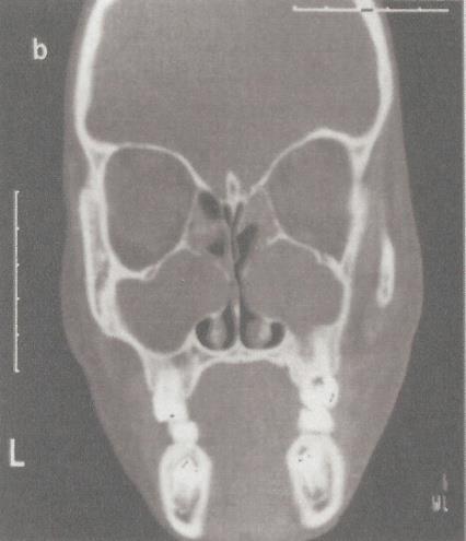 scans in an 11-year old patient with CF