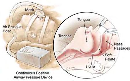 Το τοπίο αλλάζει όταν αρχίζει να χρησιμοποιείται η συσκευή συνεχούς θετικής πίεσης (CPAP) μέσω ρινικής μάσκας για την αντιμετώπιση του συνδρόμου αποφρακτικών απνοιών στον ύπνο(151).