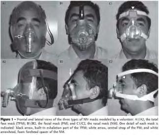 Εικόνα 15: Διάφοροι τύποι μάσκας Τα νοσήματα που ανταποκρίνονται στη χρήση του ΜηΕΜΑ χαρακτηρίζονται από νυχτερινό υποαερισμό, ο οποίος αρχικά παρατηρείται κατά τις ώρες του ύπνου.