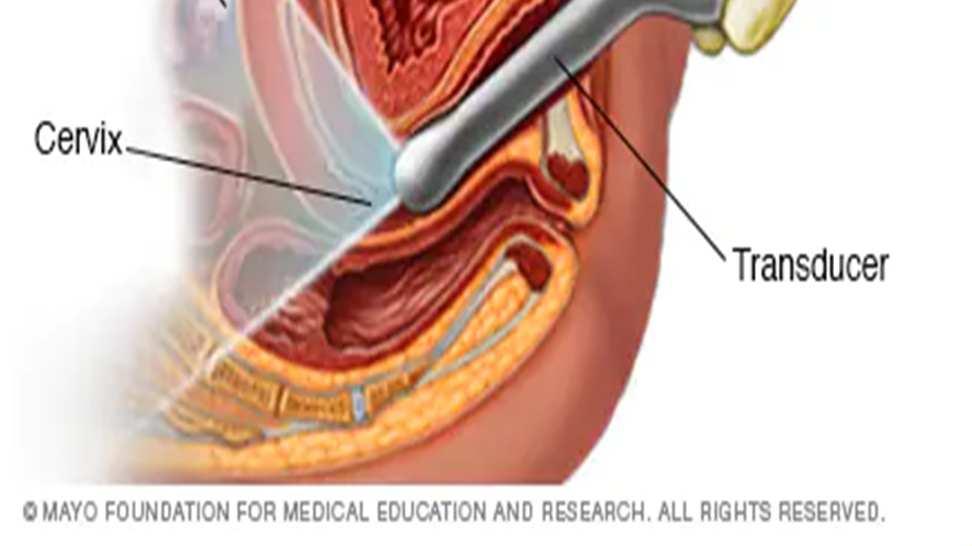 Διάγνωση της υπερπλασίας του ενδομητρίου Επειδή τα άτυπα αδενικά κύτταρα μπορεί να προέρχονται από: τον ενδοτράχηλο, το