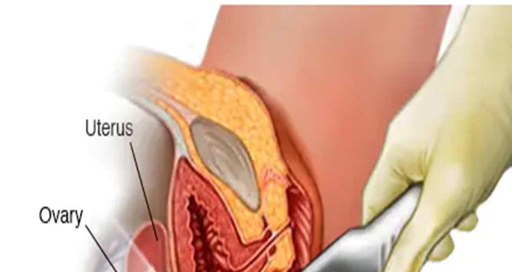 Διάγνωση της υπερπλασίας του ενδομητρίου Η υπερηχογραφική εκτίμηση του