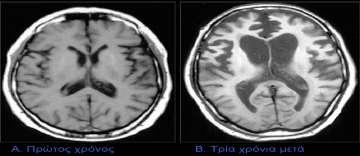 2.3.2 Διάγνωση με χρήση απεικονιστικών τεχνικών Η εξέλιξη νευροαπεικονστικών μεθόδων και κυρίως της μαγνητικής τομογραφίας (MRI) μας δίνει την δυνατότητα για μία αναλυτική ανατομική εικόνα του