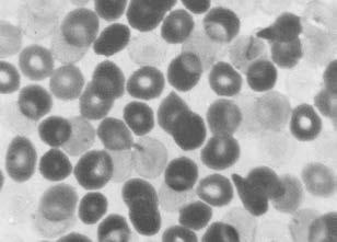 Roncevic et al 1971; Oski FA. 1972). Η HbF χαρακτηρίζεται από αυξημένη ανθεκτικότητα στη μετουσίωσή της σε αλκαλικά διαλύματα απ ό,τι η HbΑ.